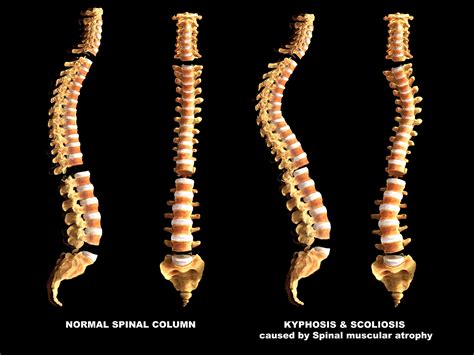 picture of the spine.